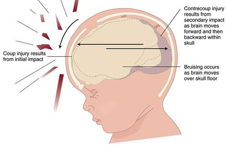 Head Injuries In Children What To Do If Your Toddler Falls And Hits His Head Working Mom Life Toddler Fall Hitting Toddler