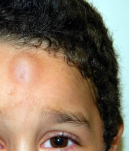 Child Bump On Head